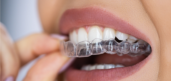 ストレスフリー